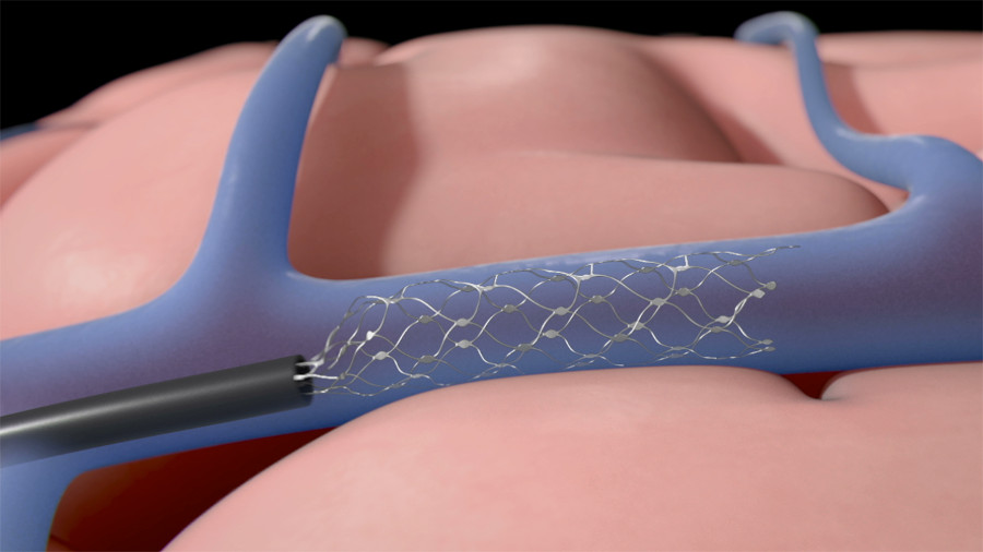 illustration of device inserting tiny wires into an artery illustration of device inserting tiny wires into an artery